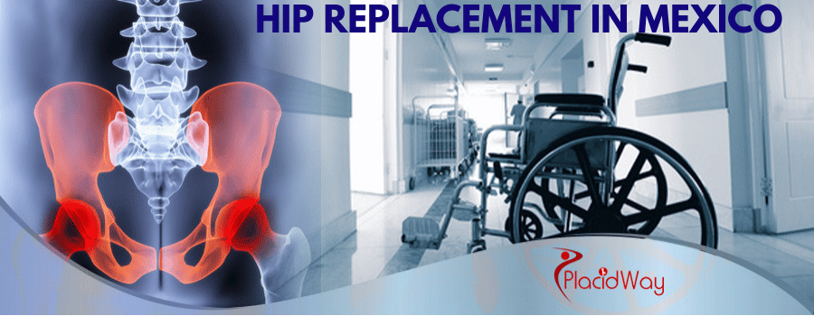 Hip Replacement surgery in Mexico